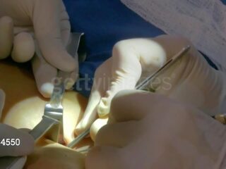 Aj sotavento desde wwe consigue su third pecho implant: gratis sucio vídeo 8e